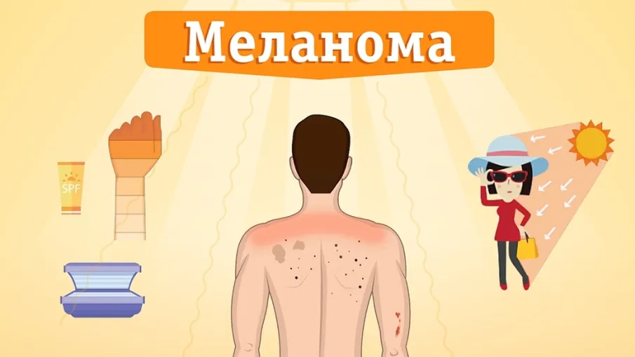 Профилактика меланомы